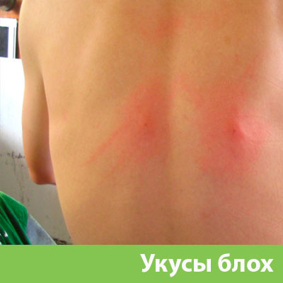 Укусы блох в Твери