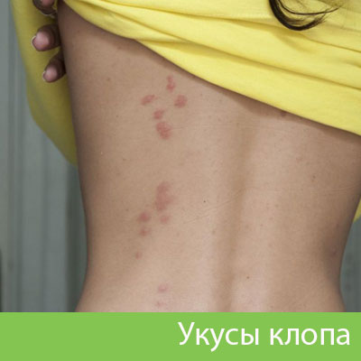 Профессиональное уничтожение клопов в Твери